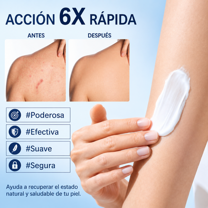 Crema para la foliculitis | Calma y ayuda a eliminar los granitos del cuero cabelludo, la cara, el cuerpo y los glúteos | Para vellos encarnados, irritación por afeitado y acné